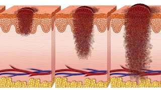 Comment définiton un ulcère de jambe [upl. by Jaynell]