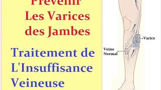 Comment Prévenir les varices et Traiter linsuffisance veineuse [upl. by Anerb155]