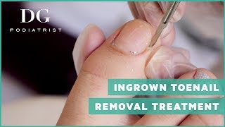 Ingrown toenail removal treatment [upl. by Percy]