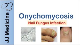 Onychomycosis  Nail Infection  Signs Symptoms Treatment [upl. by Atikram]