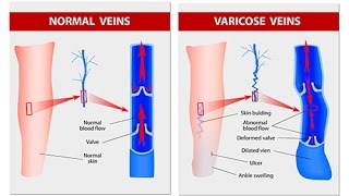 Quels sont les symptômes des varices [upl. by Peggie]