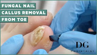 Fungal Nail Treatment And Callus Removal  The Foot Scraper DG Podiatrist [upl. by Iclehc]