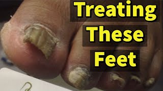 Treating These Feet A Patient With Fungal Toenails [upl. by Euqinu]