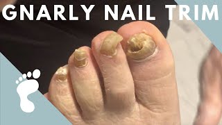 FUNGAL NAIL TRIM [upl. by Andros]