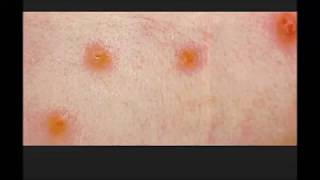 Chiggers simple facts You should know [upl. by Enomal796]