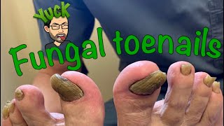 CUTTING LONG TOENAILS WITH FUNGUS [upl. by Kraul460]