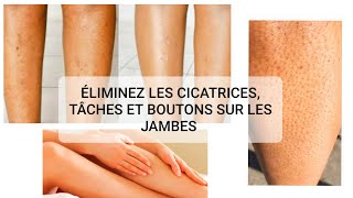 COMMENT ÉLIMINER LES CICATRICES ET BOUTONS SUR LES JAMBES [upl. by Waldo173]