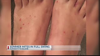 Chigger bite infestation in East Texas [upl. by Wyly]