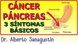 3 Síntomas del CÁNCER DE PÁNCREAS [upl. by Ellga]