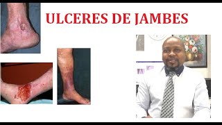 Ulcères des membres inférieurs ou de Jambes [upl. by Linea96]