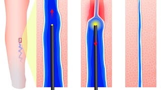 Comment se soignent les varices [upl. by Tifanie]