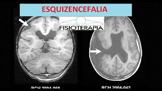 Esquizencefalia indicaciones 1 parte  Rehabilitación [upl. by Margaretha]