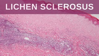 Lichen Sclerosus  Pathology mini tutorial [upl. by Marchelle467]