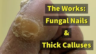 The Works Fungal Nails amp Thick Calluses 4K [upl. by Atilegna]