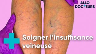 Jambes lourdes varices il existe des solutions  Allo Docteurs [upl. by Kcaz]