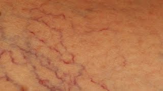 Comment se débarrasser des varices et varicosités naturellement [upl. by Ecinnahs389]