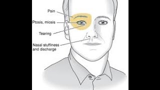 Cluster Headache [upl. by Docila174]