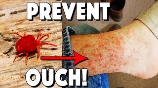 What Are Chiggers How To Treat Bites And How To Prevent [upl. by Fita]