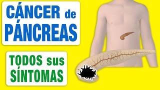 Todos los Síntomas del Cáncer de Páncreas [upl. by Ab]