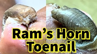 Rams Horn Toenail Severe Fungal Toenail [upl. by Trebreh450]