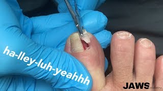 REMOVING A LARGE INGROWN TOENAIL [upl. by Chicoine168]