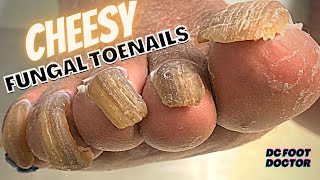 Cheesy Fungal Toenails Trimming Long Toenails [upl. by Lesko]