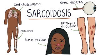 Sarcoidosis pathophysiology clinical aspects and management [upl. by Ydnarb]