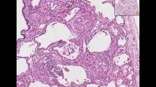 Histopathology LungSarcoidosis [upl. by Ballou147]