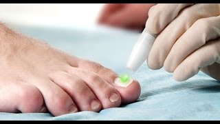 Toenail Fungus Onychomycosis treatment using the FOX Laser [upl. by Ayle]