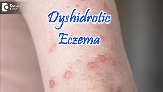 Dyshidrotic Eczema  POMPHOLYX   Causes Symptoms amp Treatment  Dr Nischal K  Doctors Circle [upl. by Anev]