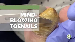 MIND🤯BLOWING TOENAILS [upl. by Iteerp]