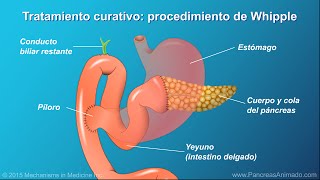 Cáncer de páncreas tratamiento y resultados [upl. by Murdoch]