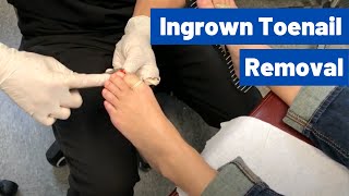 Ingrown Toenail Removal Surgery Video  Permanent Cosmetic Procedure [upl. by Tami]