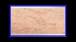 Varicosités aux jambes  remèdes naturels [upl. by Morrill]